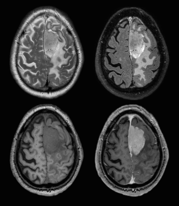 MRI-Bildgebung: Meningeom WHO Grad 2
