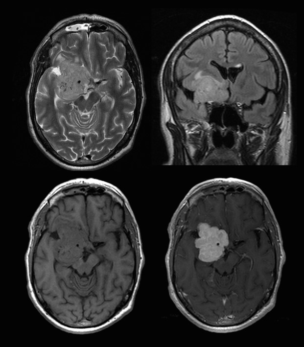 MRI-Bildgebung: Meningeom WHO Grad 3